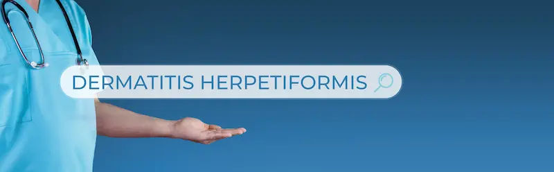 Dermatitis Herpetiformis Overview and Management